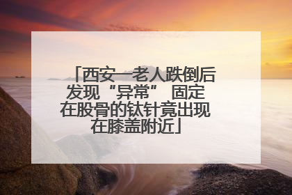 西安一老人跌倒后发现“异常” 固定在股骨的钛针竟出现在膝盖附近